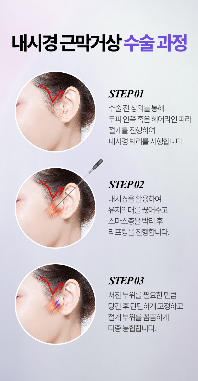내시경 근막거상 수술 과정 STEP 1. 헤어라인 위쪽 ~ 귀앞과 귓볼 부위에 절개를 통해 내시경 박리를 시행합니다. STEP 2. 내시경을 활용하여 유지인대를 끊어주고 스마스층을 박리 후 리프팅을 진행합니다. STEP 3. 처진 부위를 필요한 만큼 당긴 후 단단하게 고정하고 절개 부위를  꼼꼼하게 다중 봉합합니다.