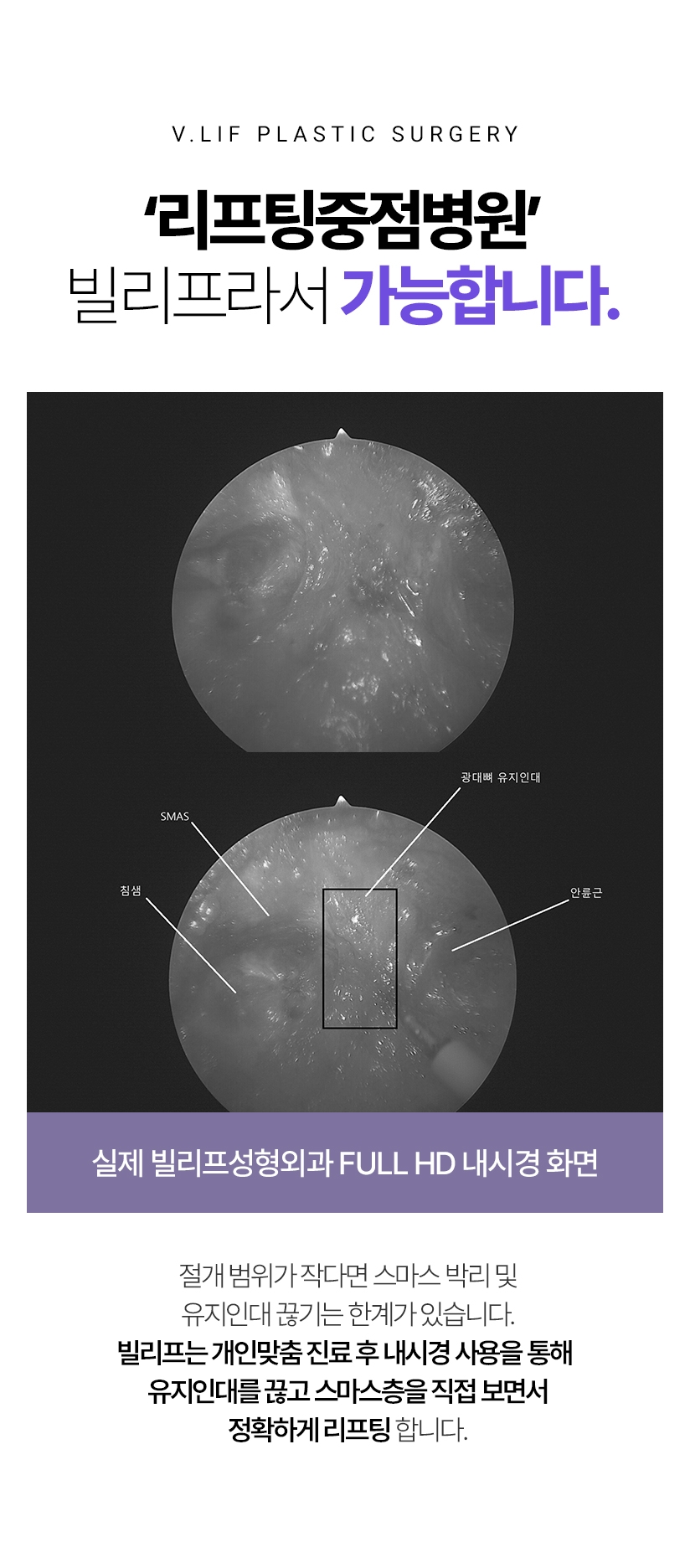 ‘리프팅중점병원’ 빌리프라서 가능합니다. 절개 범위가 작다면 스마스 박리 및 유지인대 끊기는 한계가 있습니다. 빌리프는 개인맞춤 진료 후 내시경 사용을 통해 유지인대를 끊고 스마스층을 직접 보면서 정확하게 리프팅 합니다.