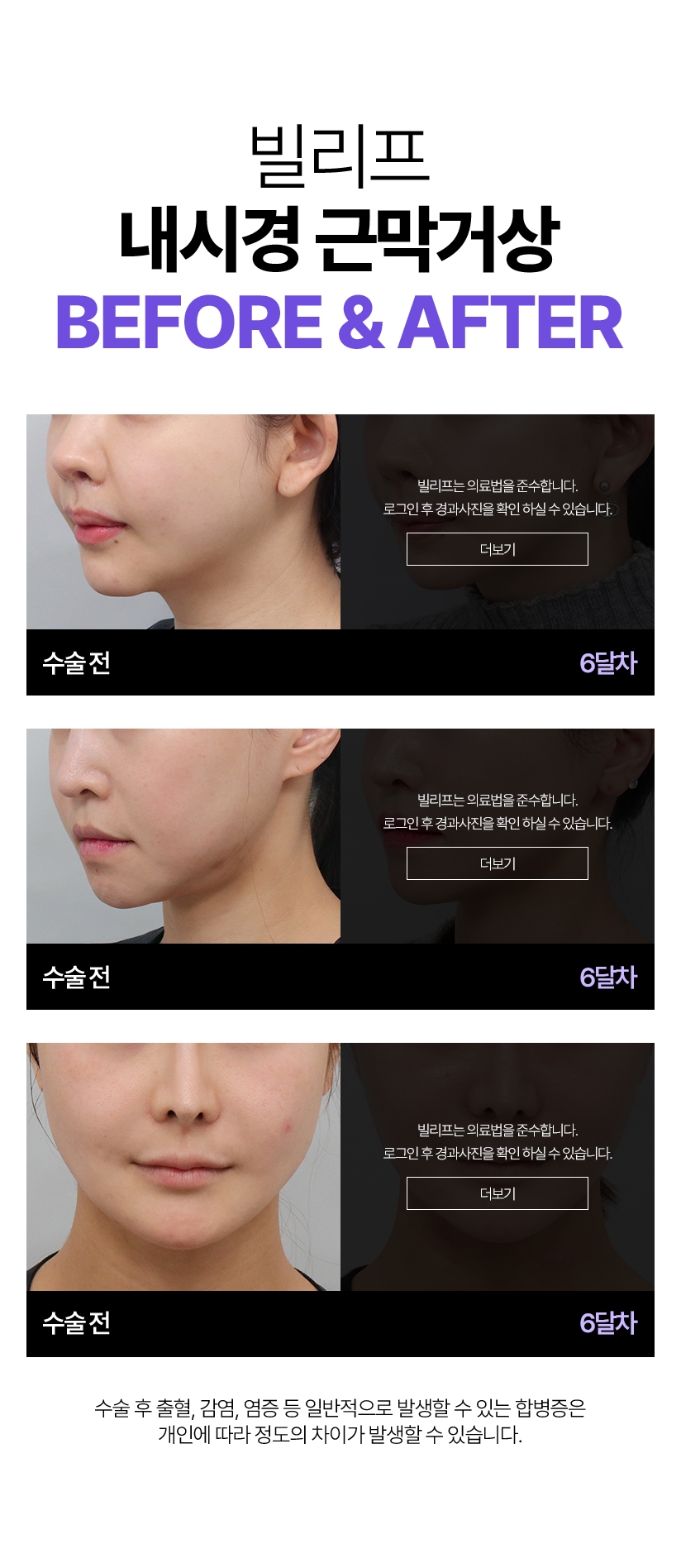 빌리프 내시경 근막거상Before & After 수술전 - 3주차, 수술전 - 6달차, 수술전 - 1달차 수술 후 출혈, 감염, 염증 등 일반적으로 발생할 수 있는 합병증은 개인에 따라 정도의 차이가 발생할 수 있습니다.