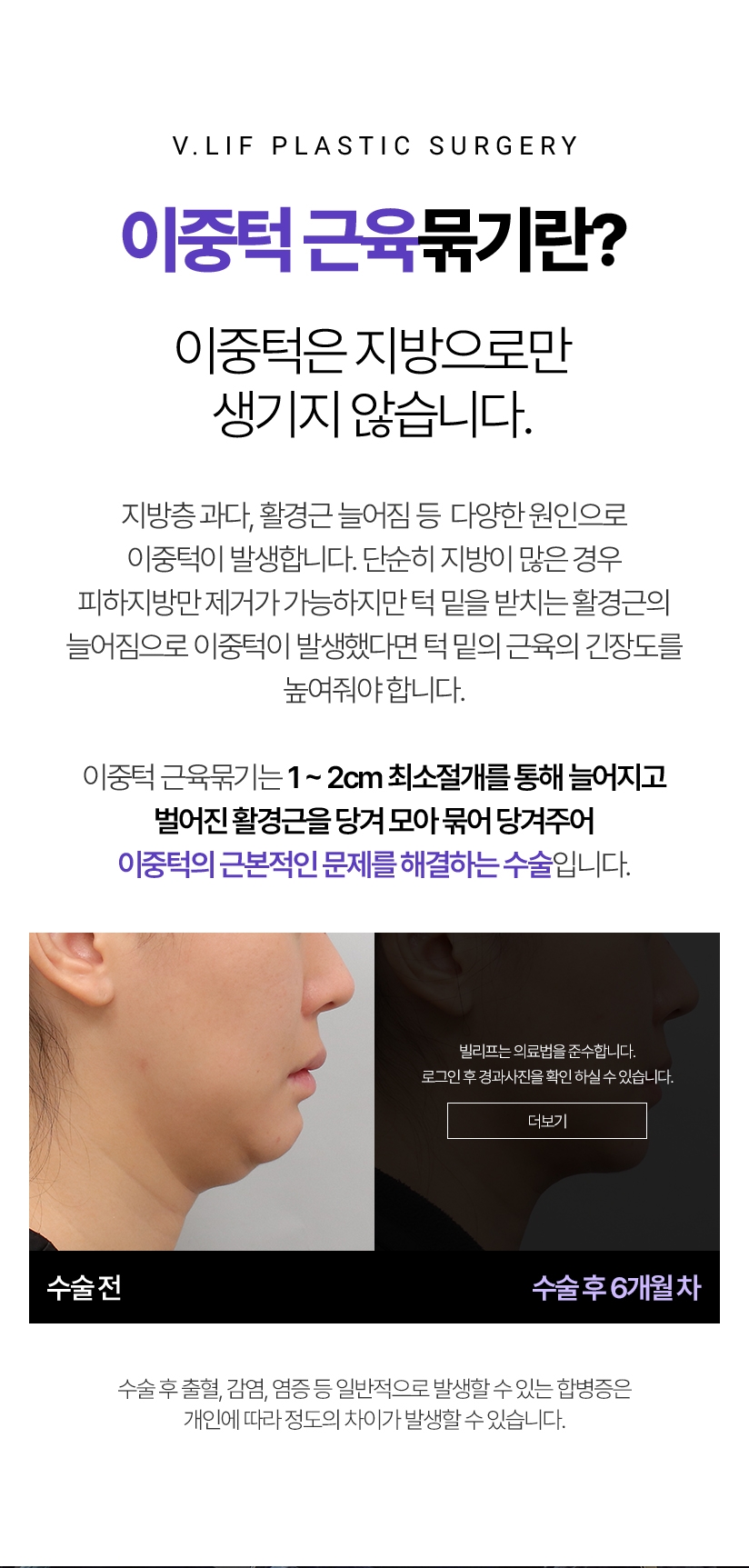 - 이중턱 근육묶기란? 이중턱은 지방으로만 생기지 않습니다. 지방층 과다, 활경근 늘어짐 등  다양한 원인으로 이중턱이 발생합니다. 단순히 지방이 많은 경우 피하지방만 제거가 가능하지만 턱 밑을 받치는 활경근의 늘어짐으로 이중턱이 발생했다면 턱 밑의 근육의 긴장도를 높여줘야 합니다. 이중턱 근육묶기는 1-2cm 최소절개를 통해늘어지고 벌어진 활경근을 당겨 모아 묶어 당겨주어 이중턱의 근본적인 문제를 해결하는 수술입니다. *수술 후 출혈, 감염, 염증 등 일반적으로 발생할 수 있는 합병증은 개인에 따라 정도의 차이가 발생할 수 있습니다.