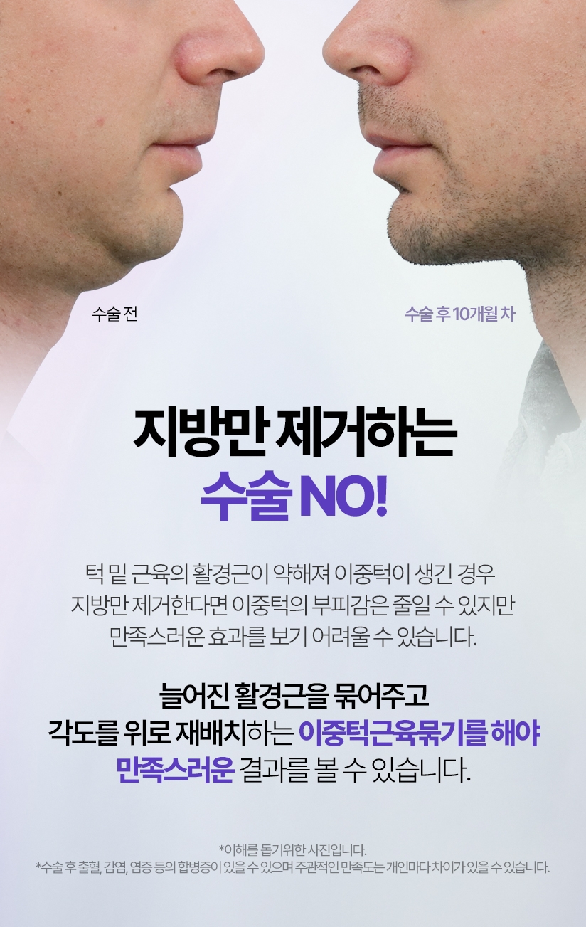 지방만 제거하는 수술 NO! 턱 밑 근육의 활경근이 약해져 이중턱이 생긴 경우 지방만 제거한다면 이중턱의 부피감은 줄일 수 있지만 만족스러운 효과를 보기 어려울 수 있습니다.늘어진 활경근을 묶어주고 각도를 위로 재배치하는 이중턱근육묶기를 해야 만족스러운 결과를 볼 수 있습니다.