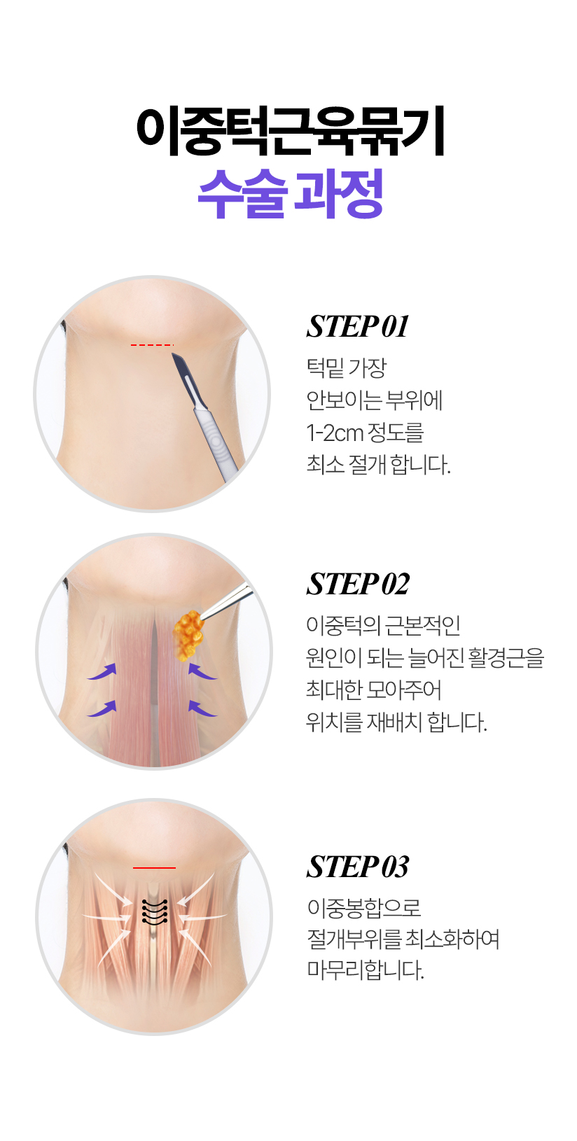 빌리프 이중턱근육묶기 수술과정 STEP 1. 턱밑 가장 안보이는 부위에 1-2cm 정도의 최소 절개 합니다./ STEP 2. 이중턱의 근본적인 원인이 되는 늘어진 활경근을 최대한 모아주어 위치를 재배치 합니다. / STEP 3. 이중봉합으로 절개부위를최소화하여 마무리합니다. 