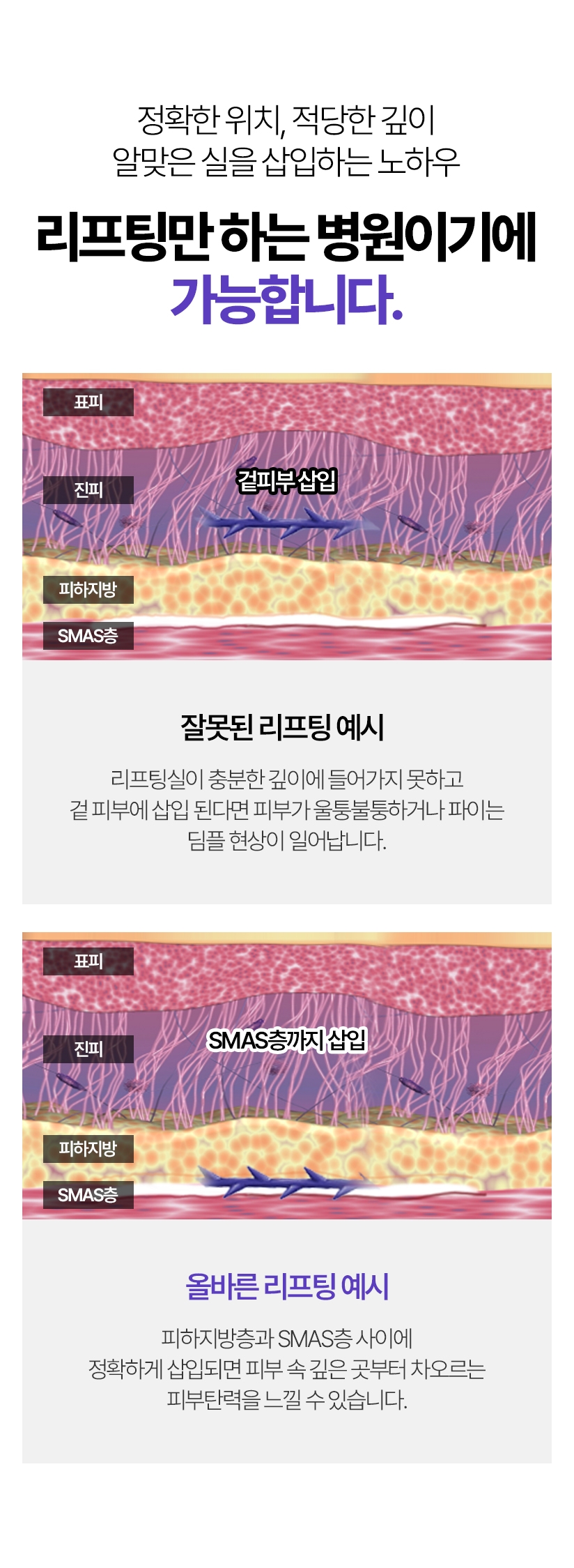 정확한 위치, 적당한 깊이 알맞은 실을 삽입하는 노하우 리프팅만 하는 병원이기에 가능합니다. 잘못된 리프팅 예시 - 리프팅실이 충분한 깊이에 들어가지 못하고 겉 피부에 삽입 된다면 피부가 울퉁불퉁하거나 파이는 딤플 현상이 일어납니다. / 올바른 리프팅 예시 - 피하지방층과 SMAS층 사이에 정확하게 삽입되면 피부 속 깊은 곳부터 차오르는 피부탄력을 느낄 수 있습니다.