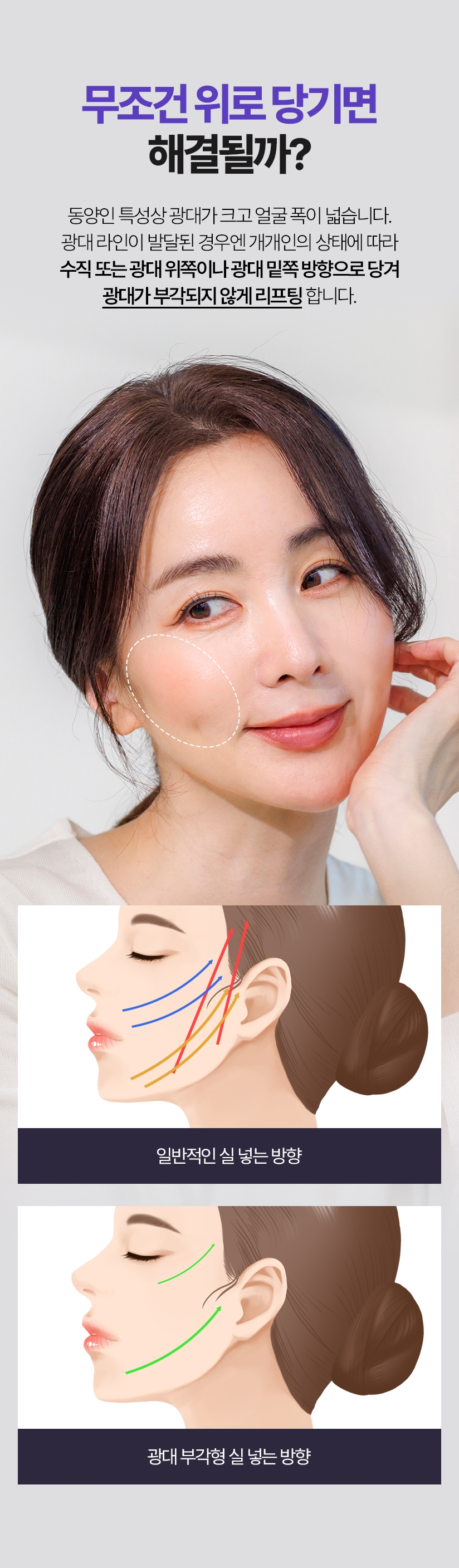 무조건 위로 당기면 해결될까? 동양인 특성상 광대가 크고 얼굴 폭이 넓습니다. 광대 라인이 발달된 경우엔 개개인의 상태에 따라 수직 또는 광대 위쪽이나 광대 밑쪽 방향으로 당겨 광대가 부각되지 않게 리프팅 합니다.
