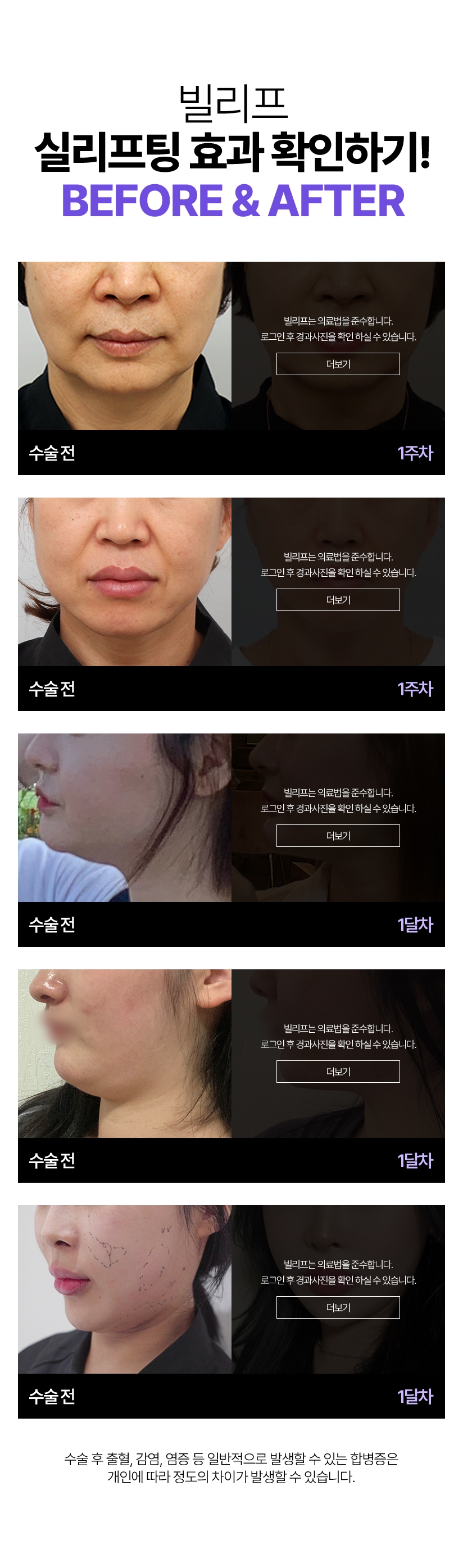 빌리프 실리프팅 효과 확인하기! 시술전 - 1주차