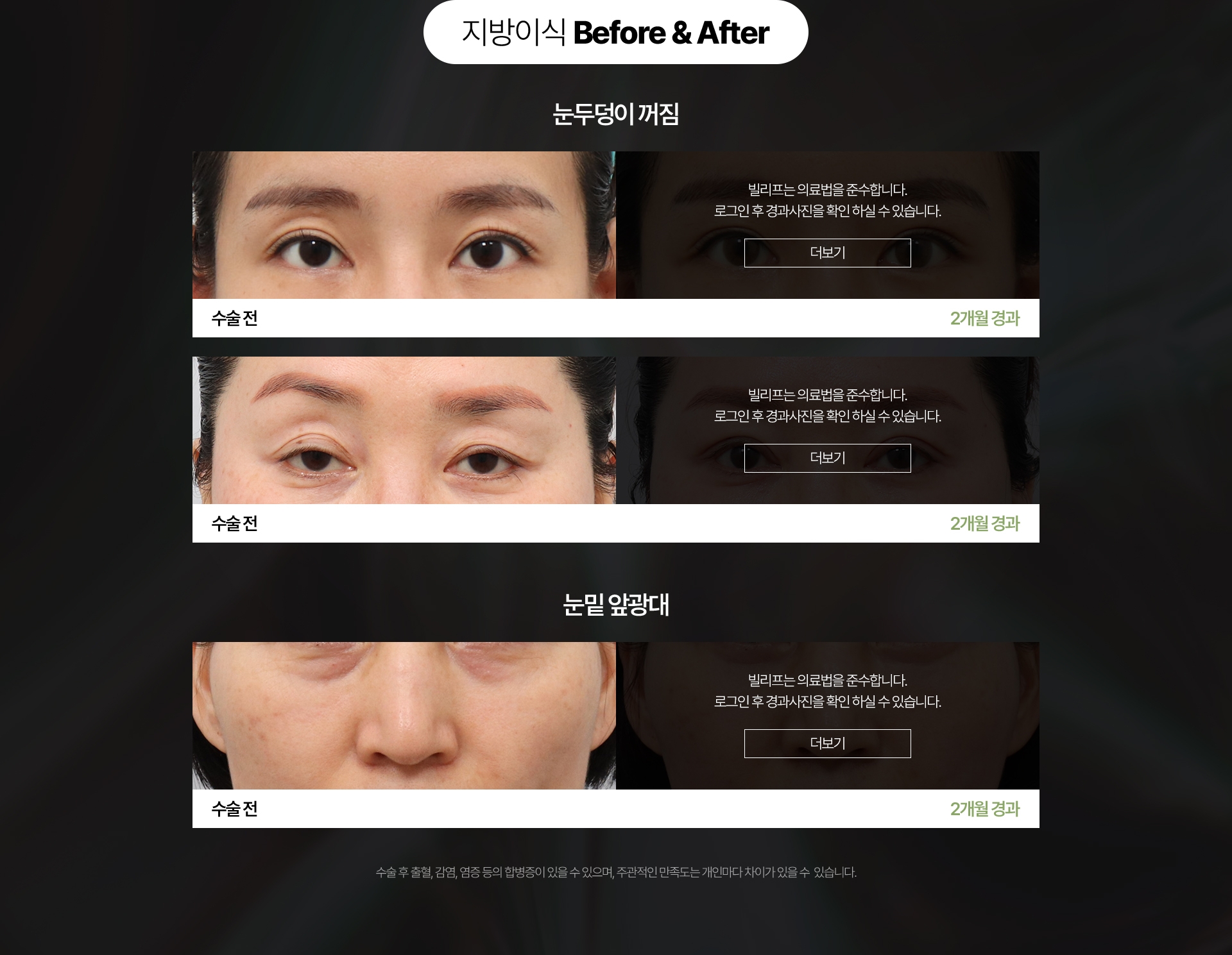 지방이식 Before & After 눈두덩이 꺼짐 수술 전 - 2개월 경과