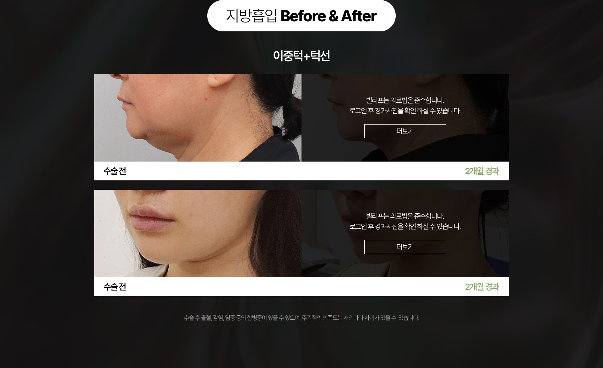 지방흡입 Before & After 눈밑 앞광대 수술 전 - 2개월 경과