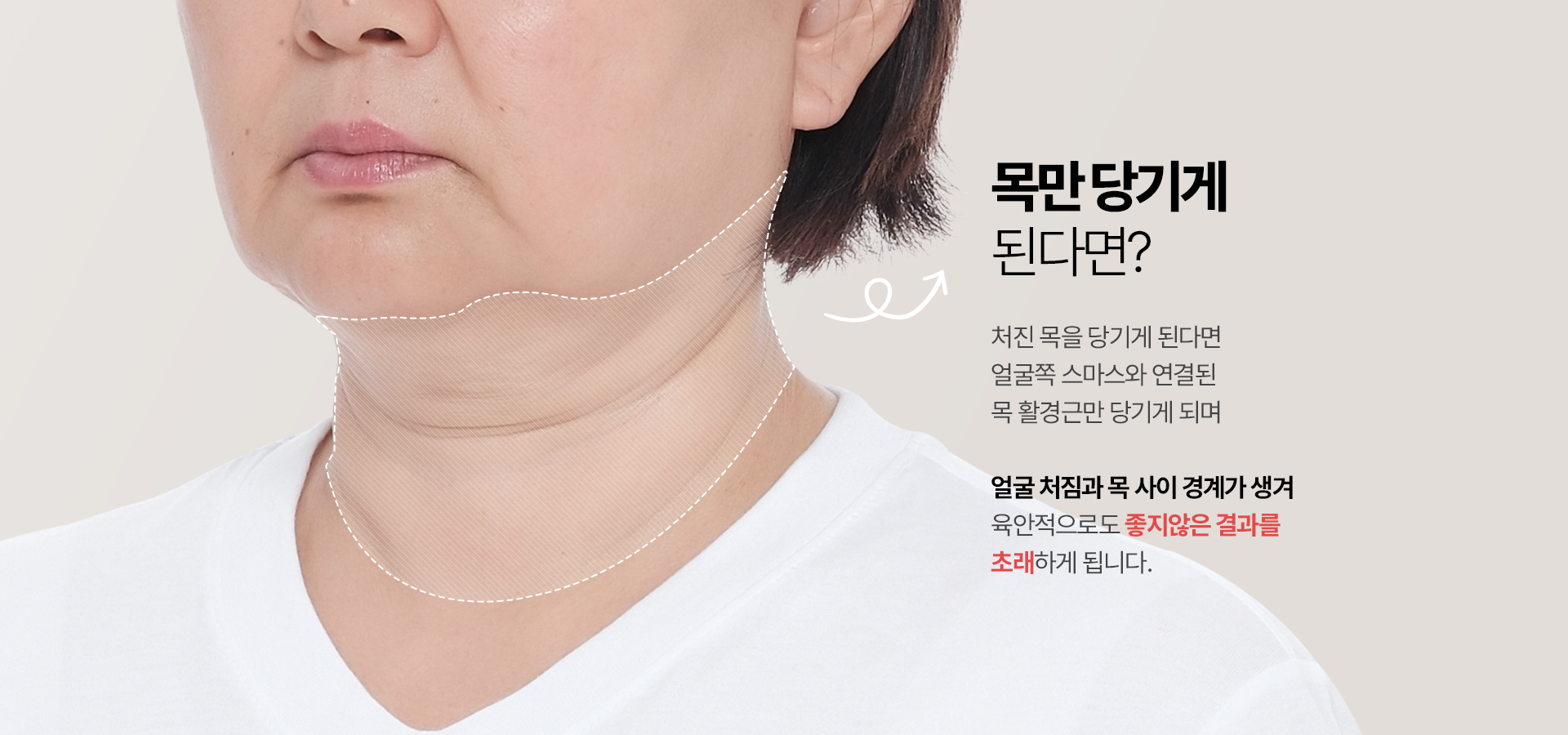 목만 당기게 된다면? 처진 목을 당기게 된다면 얼굴쪽 스마스와 연결된 목 활경근만 당기게되며 얼굴 처짐과 목 사이 경계가 생겨 육안적으로도 좋지않은 결과를 초래하게 됩니다.