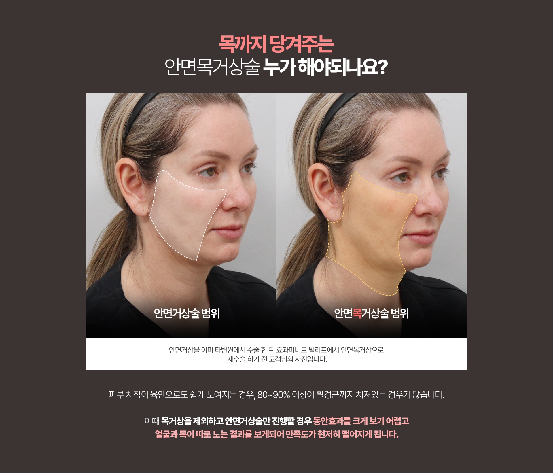 목까지 당겨주는 안면목거상술 누가 해야되나요? 안면거상술 범위/안면목거상술범위 (안면거상을 이미 타병원에서 수술 한 뒤 효과미비로 빌리프에서 안면목거상으로 재수술 하기 전 고객님의 사진입니다.) 피부 처짐이 육안으로도 쉽게 보여지는 경우 80~90% 이상이 활경근까지 처져있는 경우가 많습니다. 이때 목거상을 제외하고 안면거상술만 진행할 경우, 동안효과를 크게 보기 어렵고 얼굴과 목이 따로 노는 결과를 보게되어 만족도가 현저히 떨어지게 됩니다.