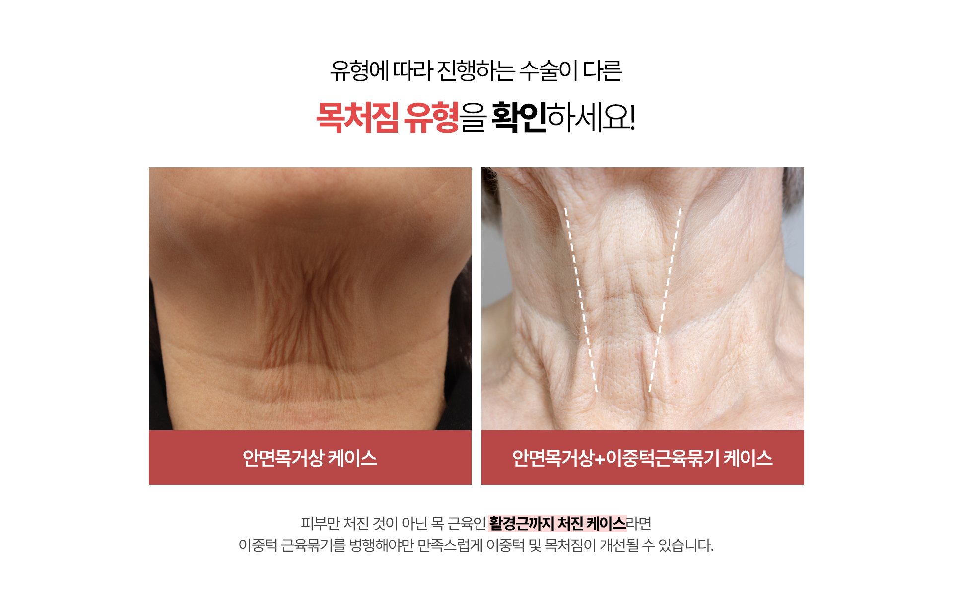 유형에 따라 진행하는 수술이 다른 목처짐 유형을 확인하세요! 안면목거상 케이스, 안면목거상+이중턱근육묶기 케이스 (피부만 처진 것이 아닌 목 근유인 활경근까지 처진 케이스라면 이중턱 근육묶기를 병행해야만 만족스럽게 이중턱 및 목처짐이 개선될 수 있습니다.)